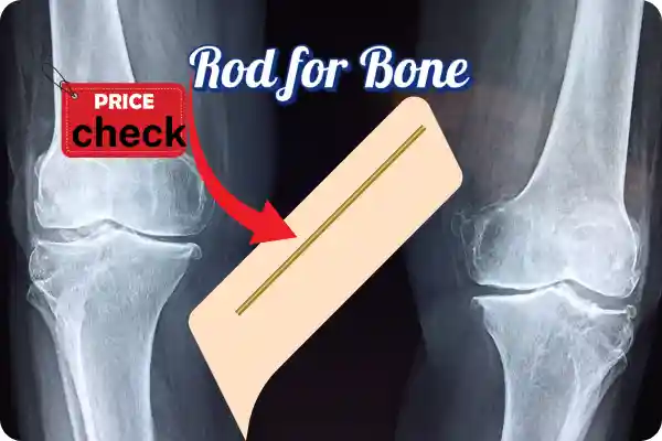 Buy rod online for bone